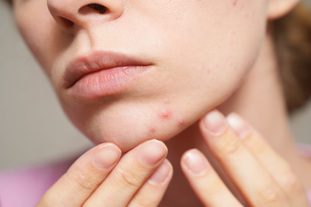 Acne behandeling