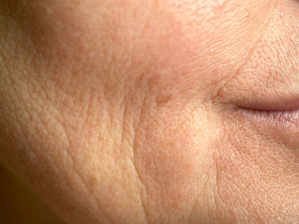 Huidverslapping en collageen verlies behandeling