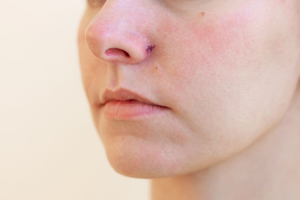 Couperose behandeling