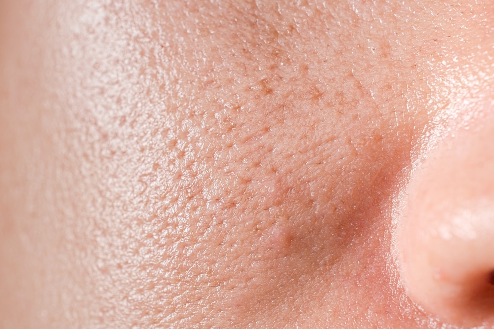 Grove poriën en mee-eters behandeling