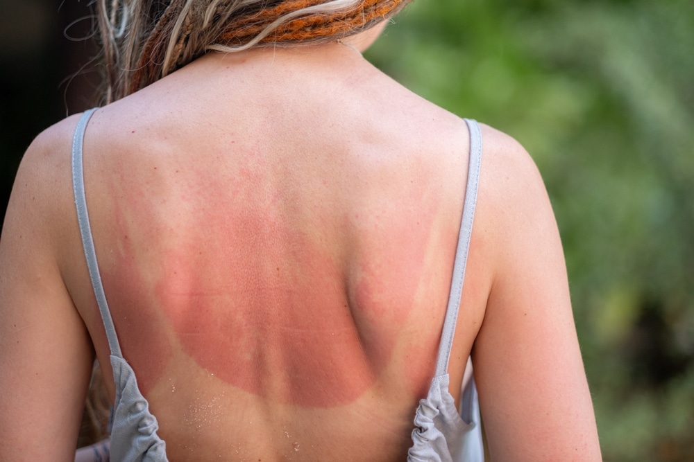 Zonbeschadiging behandeling